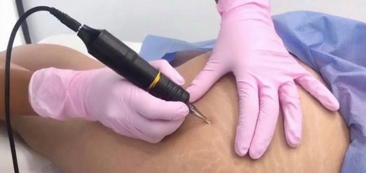 Tratamiento eliminación de Estrias