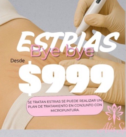 Tratamiento de estrías - ALIS SPA
